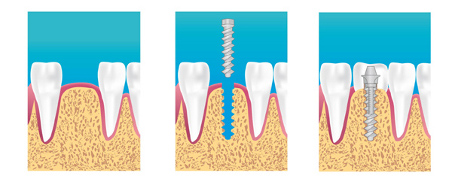implant dentaire bordeaux